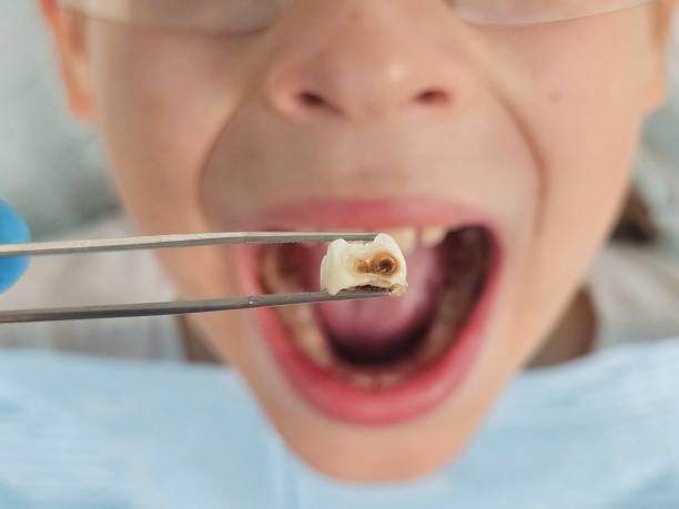 Best Emergency Tooth Extraction in East Camden, AR